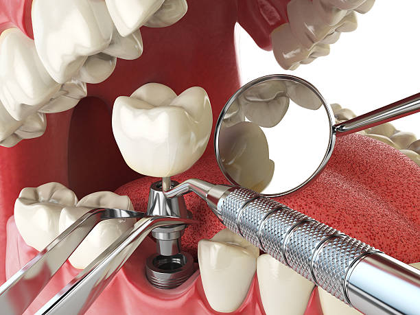 Best Knocked-Out Tooth (Avulsed Tooth) Treatment in Algood, TN